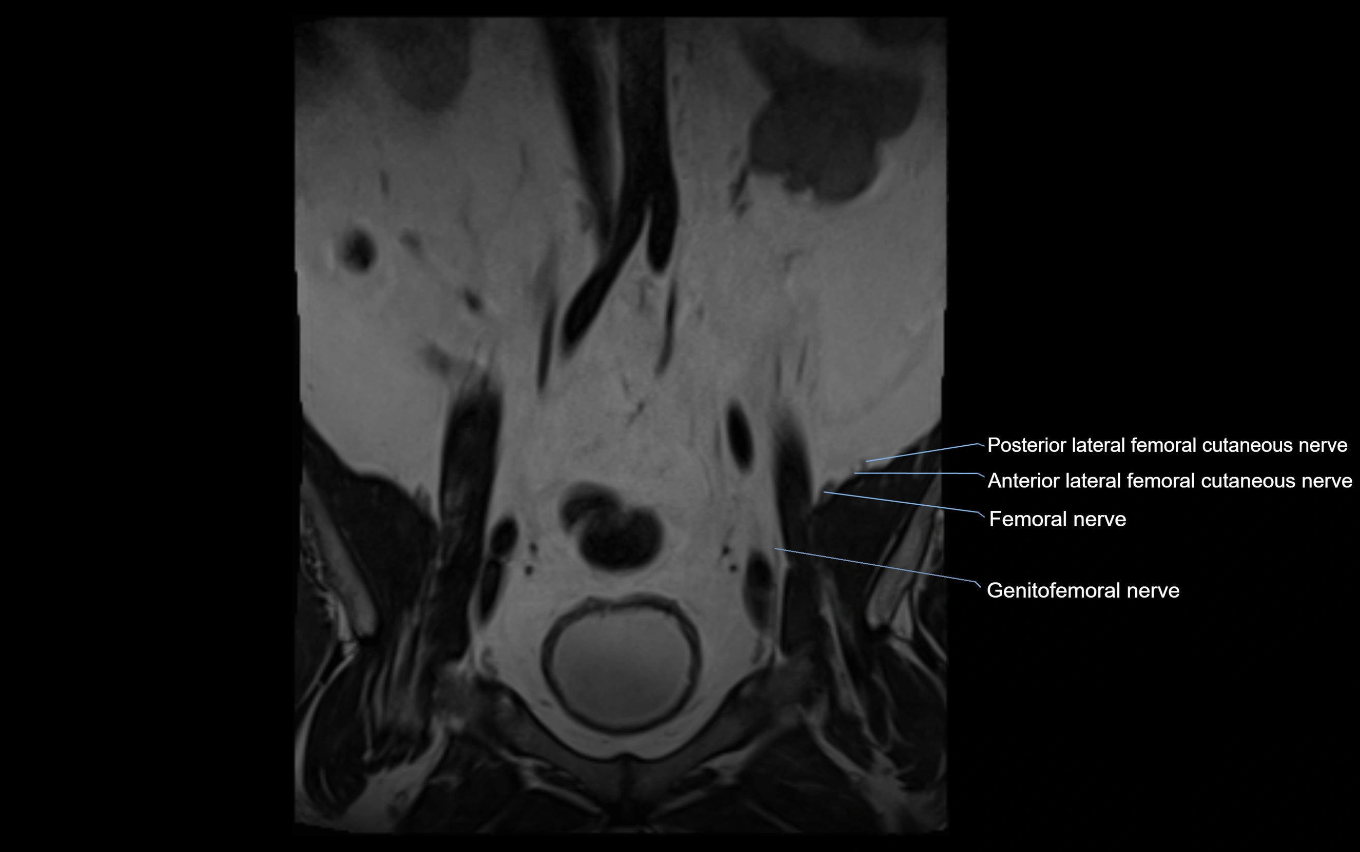 MR lumbosacral plexus cross sectional anatomy 3T  radiology  image-img-09001-00001.webp